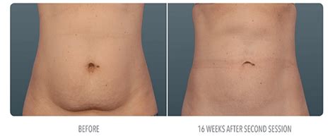 Coolsculpting Plantation Davie And Fort Lauderdale Fl The Vera Medical Institute