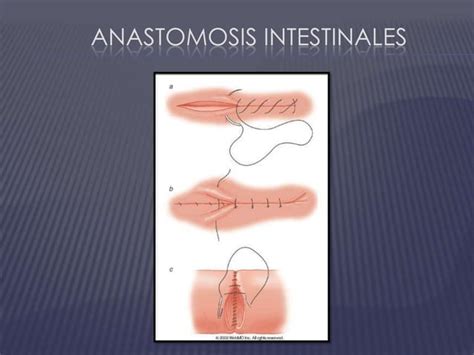 Seminario Anastomosis Intestinales PPT