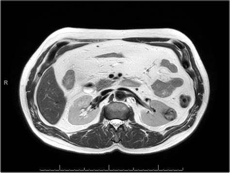 Mri Of A Tumor Mass At The Left Kidney Download Scientific Diagram