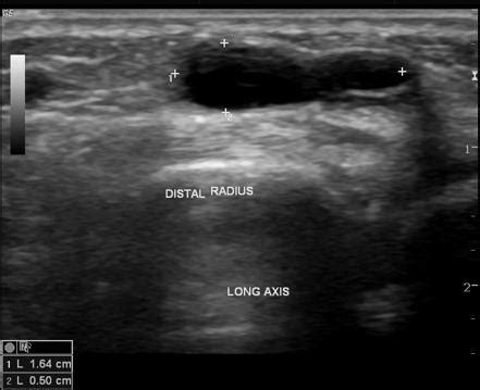 Ganglion Cyst Ultrasound