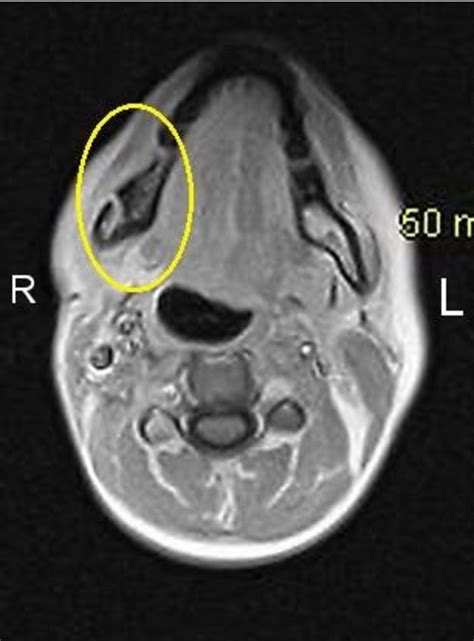 Figure 5 From Osteoradionecrosis Of The Mandible And Mastoiditis After