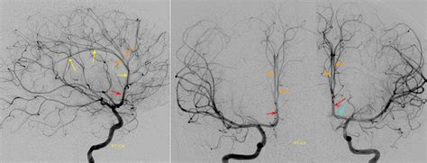 Anterior Cerebral Artery