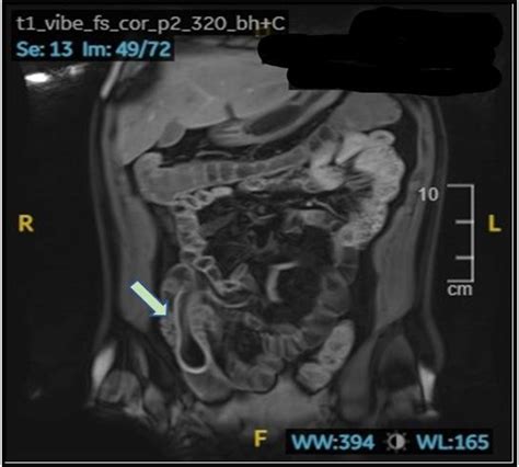 Inverted Meckel S Diverticulum A Case Report And Role Of Radiological