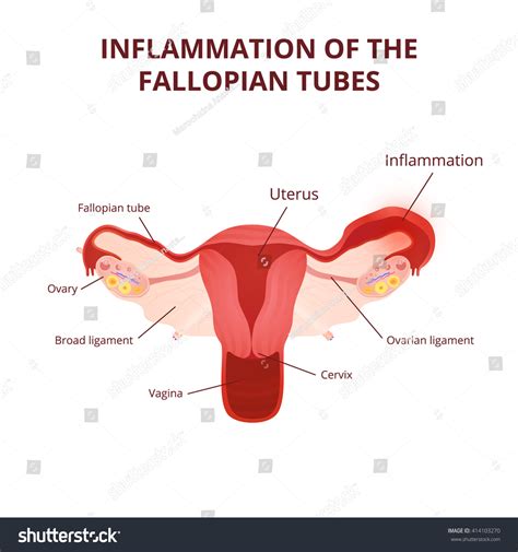 Female Reproductive System The Uterus And Ovaries Scheme Salpingitis Infection And