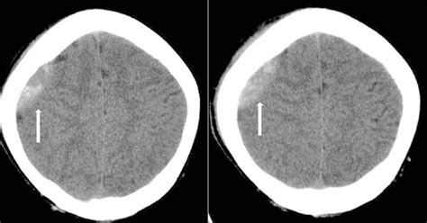 Brain Ct Showing Epidural Hematoma At The Right Fronto Parietal Lobe On