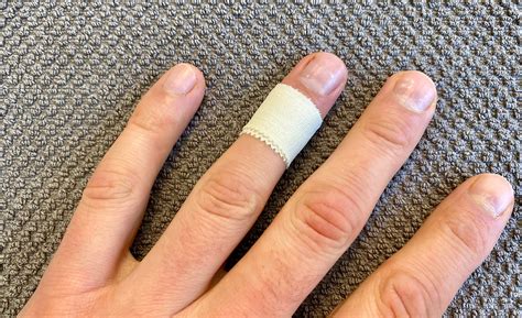 Impoliment Sommet Physiquement Finger Verstaucht Wie Lange Geschwollen