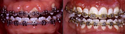 Gingival Hyperplasia Treatment