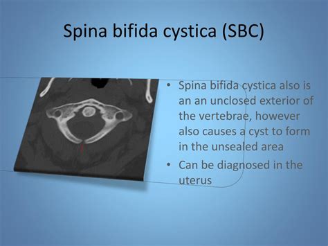 Ppt Spina Bifida Latin Split Spine Powerpoint Presentation Free