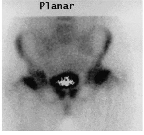 A technetium bone scan shows greatly increased isotope uptake at the ... 