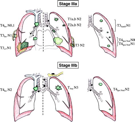 The Stage Classification Of Lung Cancer Chest