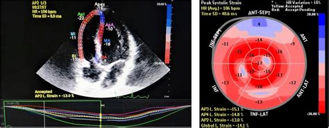 An Example Of Right Ventricular Strain Speckle Tracking Apical Four