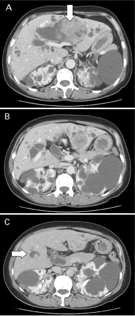 Abdominal Ct Findings Abdominal Ct Scan Showed Papillary Projected Download Scientific Diagram