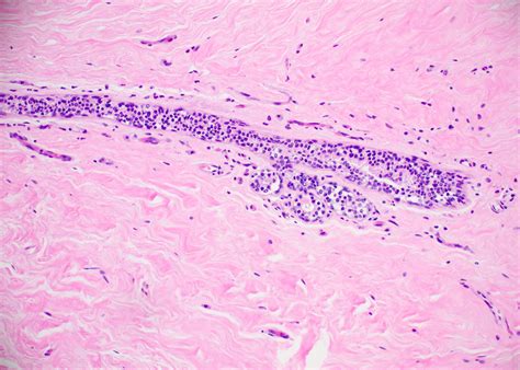 Pathology Outlines Atypical Lobular Hyperplasia