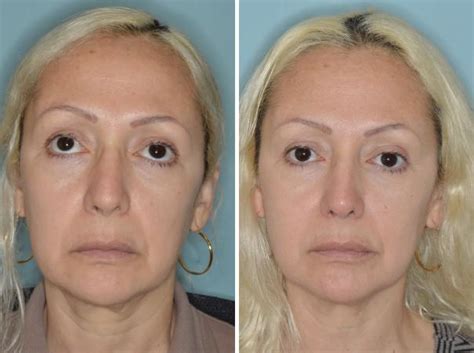 Revision Rhinoplasty Photos Dr Anthony Bared Md Facial Plastic