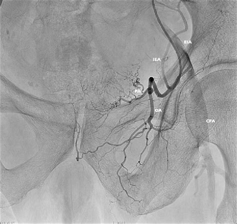 Selective Angiography Of The Left Inferior Epigastric Artery IEA In