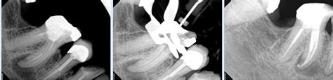 Endodontic File Fracture Broken Instrument Removal Endodontic File Fracture Removal