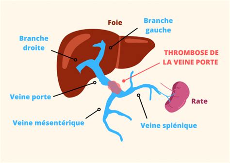 Interview du Dr Aurélie Plessier Etude RIPORT Rivaroxaban 15 mg