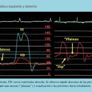 Classic Cardiac Hemodynamic Findings In Constrictive Pericarditis When