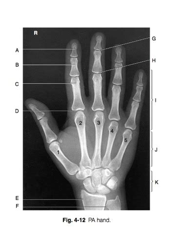 Chapter 4 Upper Extremities Flashcards Quizlet