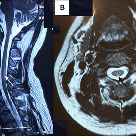 T Weighted Mr Images Of Cervical Spinal Cord In Case Sagittal Image