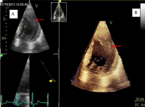 Hypertrophy And The Abnormal Position Of The Lateral Papillary Muscles