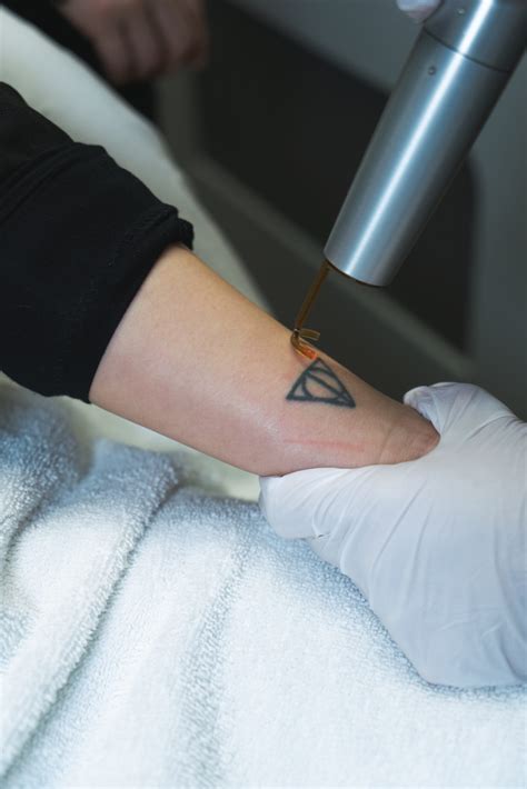 We Are The Laser Tattoo Removal Clinic In Vancouver