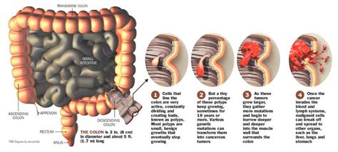 Colon Cancer and Colon Cancer Symptoms - Colon Cancer Symptoms