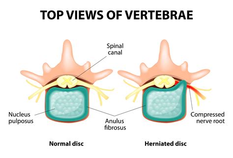 Slipped Disc Arc Of Life Chiropractic Singapore