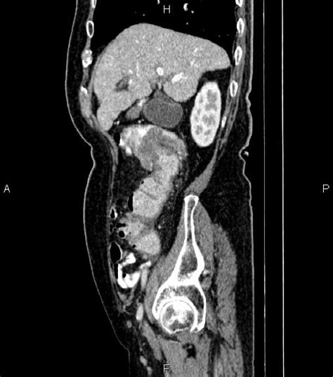 Ascending Colon Cancer Causing Intussusception Image