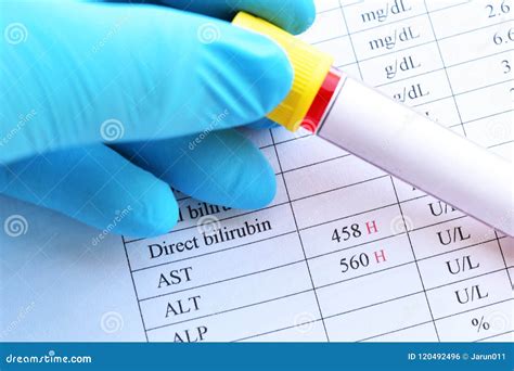 Abnormal High Liver Enzyme Test Result Stock Photo - Image of alkaline ...