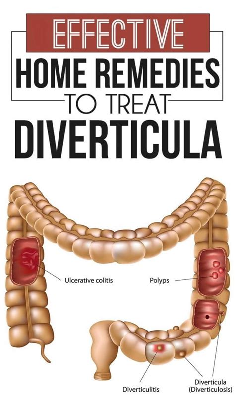 Natural Remedies For Diverticulosis That Are Worth Sharing Natural