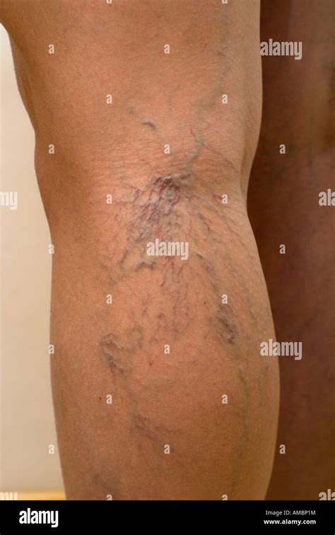 Thread Veins Of Legs Stock Photo Alamy