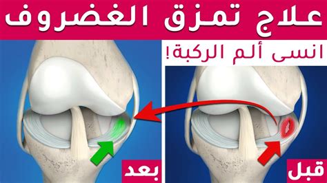 علاج فعّال 100 تمزق غضروف الركبة الهلالي وداعاً خشونة الركبة والم