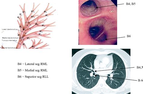 Bronchoscopy Anatomy - Anatomical Charts & Posters