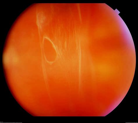 Posterior Viteous Detachment Annan Retina Eye Center In Houston Texas