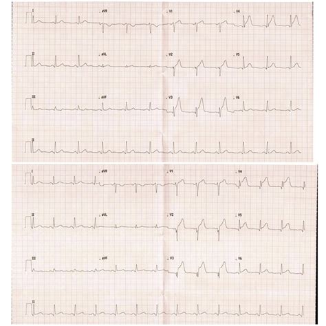 Abnormal Q Waves? : r/EKG