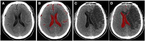 Frontiers Evaluation And Prediction Of Post Stroke Cerebral Edema Based On Neuroimaging