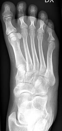 Multipartite Hallux Sesamoid Radiology Reference Article