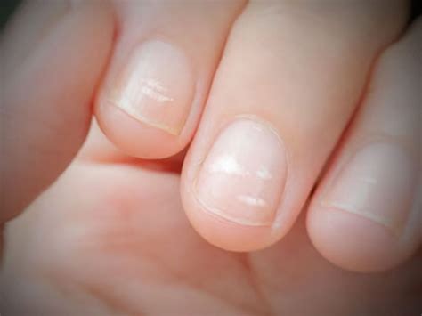 Understanding White Spots On Nails Causes And Remedies For A Flawless Nail