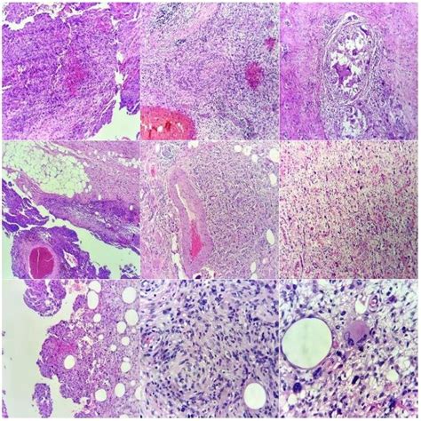 Microscopic Slices Of A Poorly Differentiated Liposarcoma Mature