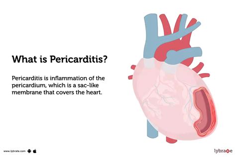 Pericarditis Causes Symptoms Treatment And Cost