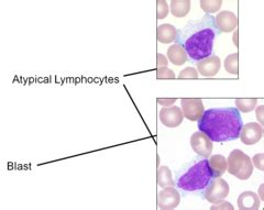 Atypical lymphocytes vs Blast 