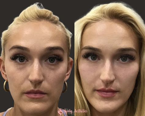 Under Eye Fillers Before And After Results At Skinly