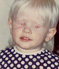 9 Best Albinism images | Albinism, Awareness, Misconceptions