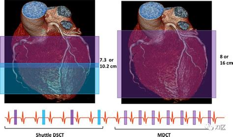 缺血性心脏病心肌特征的ct扫描研究进展：心肌灌注成像澎湃号·湃客澎湃新闻 The Paper