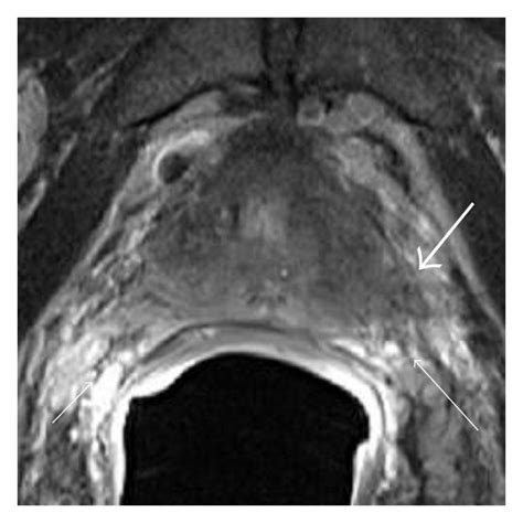 Staging Of Prostate Cancer On T2 Weighted Imaging Gross Invasion Of An