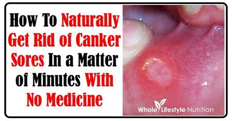 How To Heal A Canker Sore Fast - The Homestead Survival