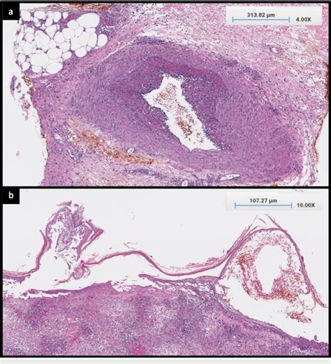 (a) H&E stain, x4 magnification, necrotizing vasculitis involving all ...