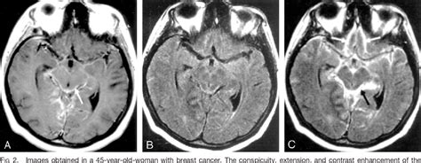 Figure From Imaging Of Intracranial Metastases Fluid Attenuated