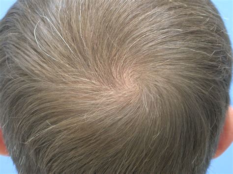 crown hair loss